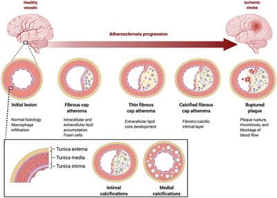 Intracranial Arterial Calcifications: Potential Biomarkers of Stroke Risk and Outcome